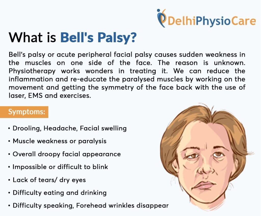 Top Bell’s Palsy Treatment in Delhi | Delhi Physio Care